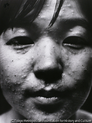 作品画像：ガス弾の後遺症（東大闘争）